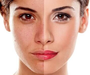 facial skin changes after laser peeling