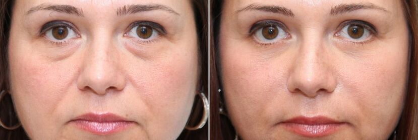 Before and after blepharoplasty - removal of the fatty body under the eyes and skin tightening